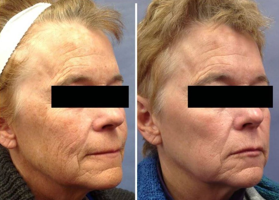 Halo Treatment